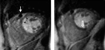 Figure 1. First pass perfusion images at rest (left) and adenosine stress (right). White arrow: stent artifact; black arrow: myocardial infarction; open white arrow: ischemia.