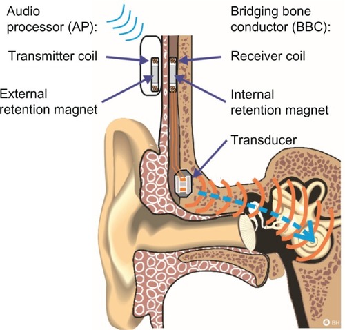 Figure 1 Illustration of the bone conduction implant system.
