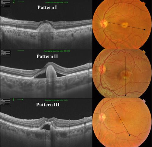 Figure 1 Patterns of BVMD lesion on SS-OCT scans. Pattern I consists of a homogeneous subretinal hyperreflective dome-shaped lesion with overlying retinal thinning and no neurosensory retinal detachment. Pattern II consists of a solitary subretinal hyperreflective elevated lesion surrounded by localized neurosensory retinal detachment. Pattern III consists of subretinal hyperreflective amorphous material scattered within localized neurosensory retinal detachment.