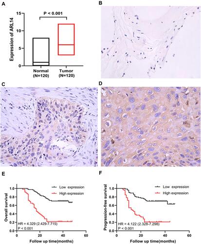 Figure 5 IHC staining and survival analysis of ARL14 in human NSCLC. (A) ARL14 expression of IHC on 120 human NSCLC tissues and 120 adjacent normal lung tissues. (B) Immunohistochemical staining for ARL14 expression in adjacent normal lung tissues (×400). (C) Immunohistochemical staining for low ARL14 expression in NSCLC tissues (×400). (D) Immunohistochemical staining for high ARL14 expression in NSCLC tissues (×400). (E) Kaplan–Meier plots of OS according to ARL14 expression. (F) Kaplan–Meier plots of PFS according to ARL14 expression.