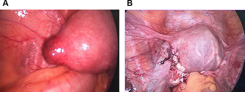 Figure 2 (A) Left cornua before laparoscopy (2019). (B) Laparoscopic removal of ectopic pregnancy sac and diathermy (2019).