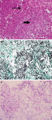 Figure 2. 2a. Haematoxyllin and eosin stain (large cluster of fungal hyphae shown by thick arrow) 2b. Grocott-methenamine silver stain (fungal hyphae seen in black) 2c. Periodic acid Schiff stain.