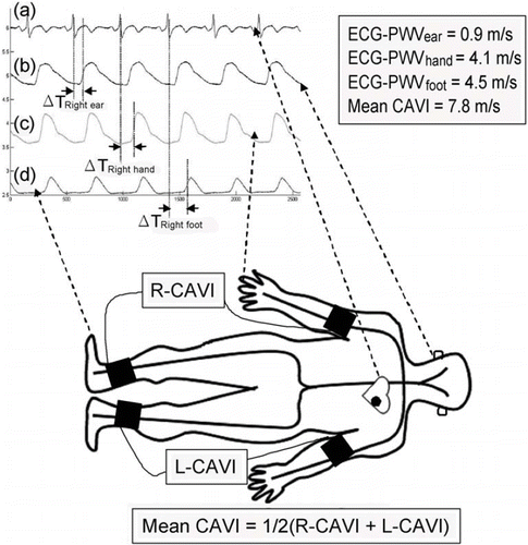 Figure 1. Schematic illustration of the measurements of six-channel electrocardiogram-based pulse wave velocity (ECG-PWV) and cardio-ankle vascular index (CAVI). With (a) R wave on Lead II as a reference point, the time differences (ΔTi) to (b) ear lobe, (c) index finger and (d) second toe were obtained. ECG-PWV was calculated by dividing the distances from different points of reference (Li) with ΔTi (i.e. ECG-PWVi = Li/ΔTi). Mean CAVI was obtained by averaging the values from both sides of the body as shown in the equation.