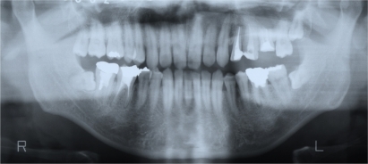 Figure 1 Bilateral horizontal incompletely impacted third molars with lamina dura below the crown in a 36-year-old man.