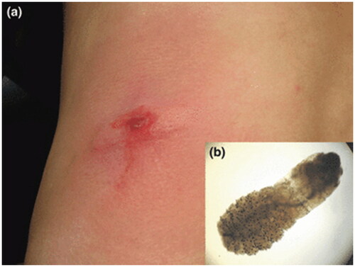 Figure 6. Cutaneous myiasis. Erythematous nodule with Central pustulation (a) and larva of C. anthropophaga, 7 mm long with an oval body and numerous black spines (b). Reprinted with permission from: Deng et al. [Citation74], with permission from John Wiley and Sons.
