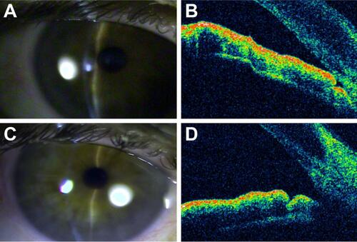 Figure 1 (A) Closed iridocorneal angle observed with a slit lamp. (B) Closed iridocorneal angle observed by optical coherence tomography (OCT). (C) Open iridocorneal angle after phacoemulsification observed with a slit lamp. (D) Open iridocorneal angles after phacoemulsification observed by OCT.