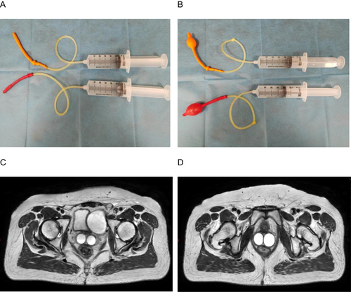 Figure 1 (A and B) Images of two inflated balloons with a sterile physiological salt solution. (C and D) T2-weighted magnetic resonance images were obtained after two inflated balloons with sterile physiological salt solution filled the double vagina.