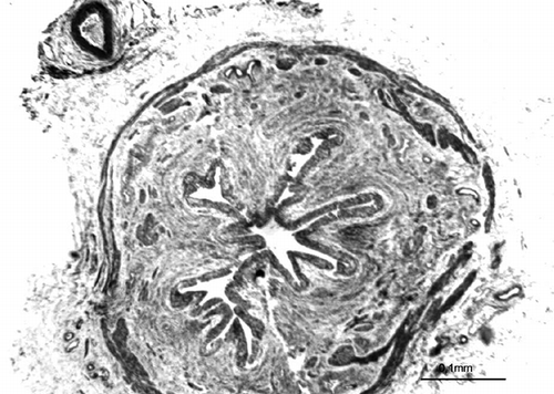 Figure 4.  Photomicrograph of PUJO group showing the morphology of uroepithelium in an obstructed pelviureteral junction (H&E).