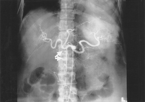 Figure 3. Coeliac and superior mesenteric angiogram showed multiple microaneurysms in the gastroduodenal artery territories (arrow).