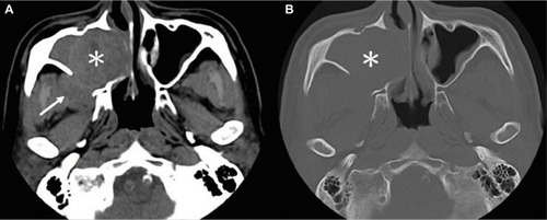 Figure 2 CT imaging of sinonasal angiomatous polyp.