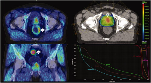 Figure 1. Axial (A) and coronal (C) ACE-PET/CT views of a patient with intermediate-risk prostate carcinoma. Dose distribution in basal left peripheral metabolic target volume (MTV, arrow) is shown in planning CT (B) and DVH of MTV, PTVhigh-risk, and PTVlow-risk and critical normal tissues (D). Note physiologic tracer activity of rectal (A) and sigmoid wall (C) indicated with arrows. The patient is recurrence-free 9 years after biologically guided RT.