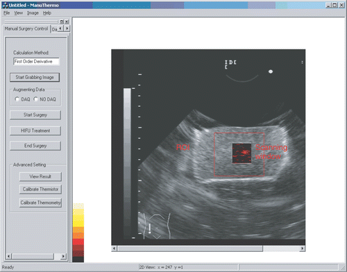 Figure 13. Image display on GUI window shown as a result of fusion of sensory data for lesion tracking and thermal mapping. [Color version available online.]