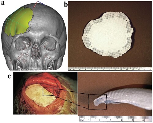 Figure 2. An example of scanning stereolithography used to print a patient-specific bioceramic implant. (a) Implant designed with the aid of CAD software using scan of patient skull. (b) 3D-printed hydroxyapatite implant with macroporous regions to promote osseointegration. (c) Intraoperative view of the implant in the defect region, also depicting how the edges of the implant are not thin enough to completely overlap the surrounding bone [Citation29].