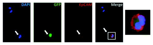 Figure 2. Images of a representative bladder cancer-derived CTC. C2’s blood sample was incubated with the probe and then fixed and stained to allow for CTC verification. A representative microscopy image of an identified CTC is demonstrated from left to right: DAPI staining for cellular nuclei and identification of three cells in field of view, GFP staining indicating cell with active telomerase expression, anti-EpCAM staining indicating epithelial origin of cell, merge demonstrating probe identified bladder carcinoma CTC, and magnification of merge demonstrating GFP expression and co-staining of DAPI and anti-EpCAM. White arrow denotes the CTC in the field of view. DAPI, 4’,6-diamidino-2-phenylindole; GFP, green fluorescent protein; EpCAM, epithelial cell adhesion molecule; CTC, circulating tumor cell.