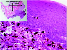 Figure 5. The microscopic photo of surgical specimen (H&E-stained section). The melanoma cells containing coarse-brownish melanin are scattered in the upper layer of the squamous epithelium, which are regarded as ‘ascending melanocytes’.