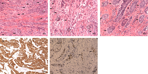 Figure 3 Postoperative histopathological examination of resected lesion showed diffuse infiltrative growth of the mass with hematoxylin and eosin (H&E) stain at 200× magnification. (A) In the typical zone of the lesion, a large number of nest-like heterotypic cells were seen within the fibrous stroma of dermis. Some cells contained large, oval or round nuclei and vacuolated clear cytoplasm (black arrows), and some had vesicular nuclei with small nucleoli could be observed and nuclear division easily visualized (black circle). (B) Spindle sarcoma-like cells were visualized in part of the sarcomatous zone of the lesion (black arrows) which had a transition between the nest-like component zone (black circles). (C) In the BCC zone of the lesion, some tumor cells in the superficial dermis were found to be small nest-like (black arrows), and some basal cells arranged in a palisading pattern like BCC. IHC staining (EnVision Method) was performed on the neoplasm and revealed CK5/6 strongly positive at 100× magnification (D) and AR focally positive (black arrows) at 200× magnification (E).