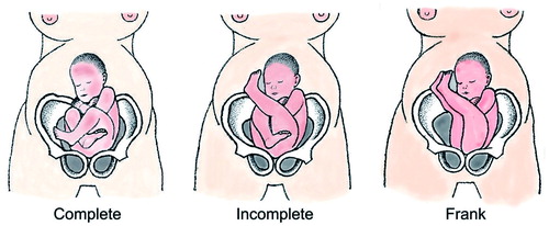 Figure 2. The different categories of breech position. Complete breech is where the knees are held in a fixed flexed position. Incomplete breech is where one knee is kept flexed while the other is extended. The most frequent type is the frank breech position, where the knees are fixed extended while the hips are flexed.