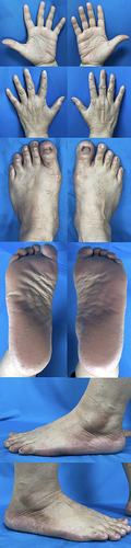 Figure 3 Improvement of skin lesions after capecitabine was discontinued.