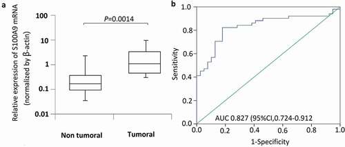 Figure 1. S100A9 mRNA levels in 56 osteosarcoma tissues and 39 normal bone tissue samples. The relative expression level of S100A9 was normalized to b-actin. (a) Box plot of S100A9 expression levels in osteosarcoma tissues and normal bone tissues. The boxes indicate the 25th and 75th percentiles, and the bold lines represent the median values. The relative expression levels of S100A9 were normalized to b-actin. Statistically significant differences were determined using Mann–Whitney tests or Kruskal–Wallis tests. B. Receiver operating characteristics (ROC) curve analysis of the diagnostic value of S100A9.