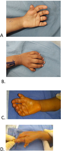 Figure 1 Physical appearances of the hands: (A and B) Twin A left hand; (C and D) Twin B right hand.