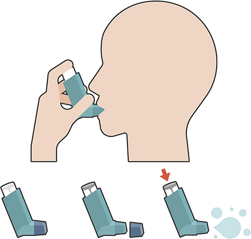 Figure 2 Use of a pressurized inhaler and aspiration of a plastic cable clip that was accidentally in the mouthpiece of the inhaler before use (Figure 1). The inhaler was stored in the pocket without the cap after it was lost. Depressing the inhaler plunger resulted in the release of the inhalent within high velocity spray, which was inhaled with a deep breath while simultaneously aspirating the plastic cable clip into the lung.