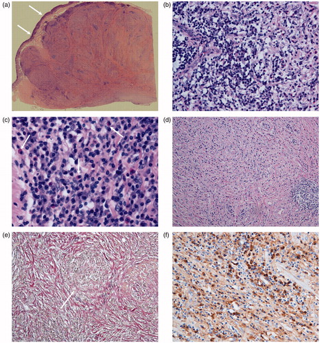 Figure 3. Histopathological specimens of the resected gastric lesion (a–d): H&E staining, (e): Elastica-van Gieson staining, and (f): IgG4 staining. Resected mass is located in the submucosa extending to sub serosal region, and overlaying mucosa is preserved (a: arrows). The mass consists of diffuse lymphoplasmacytic infiltration (b), eosinophils (c: arrows), and dense fibrosis (d). Obliterative phlebitis is also noted (e). In immunostaining of IgG4, abundant IgG4-positive plasma cells are noted.