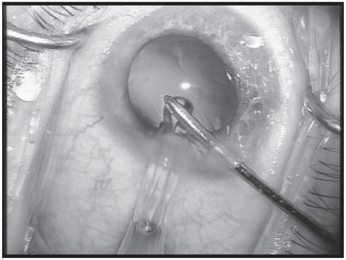 Figure 2 Placement of the tip of the injector at the 2.6 mm incision and injection of the IOL with the irrigation port of the bimanual I/A.