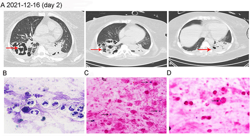 Figure 1 The diagnosis of admitted patient. (A) Date of computed tomography: 2021-12-16; Red arrows indicated the change of the lesion sites; (B) Diff-quik stain, ×100; (C) Gram stain, ×100, the black arrow refers to clusters of Gram-positive cocci; (D) Gram stain, ×100, the black arrow refers to gram-positive cocci underwent phagocytosis by polymorphonuclear leukocytes.