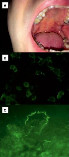 Figure 1 A young male with MMP in whom no serum anti-BP180 and anti-BP230 IgG autoantibodies were detected with multianalyte ELISA. (A) A large erosion with irregular borders causing painful swallowing on the soft palate (A); (B) BIOCHIP mosaic-based IIF revealing positive reaction of IgG4 autoantibodies with membrane-bound recombinant α3 subunit of laminin 332 (LAMA3) (original objective magnification x 40); (C) DIF of perilesional mucosal tissue showing linear IgG4 deposits along the epithelial basement membrane (original objective magnification x40).