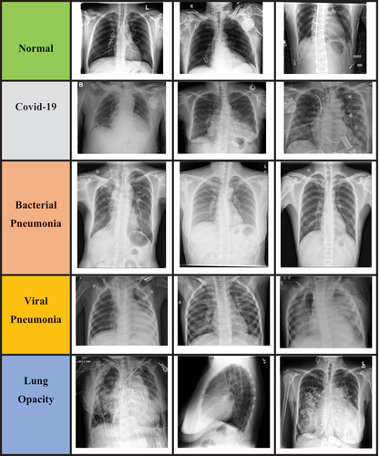 Figure 1. Chest X-ray images of normal, Covid-19, bacterial pneumonia, viral.