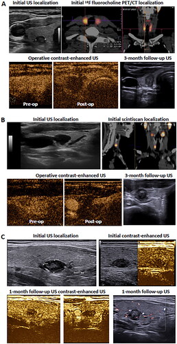 Figure 2. Imaging of the three cases. (A) Initial localization of I-PA was achieved by ultrasound (US) and 18F fluorocholine PET/CT. Pre- and post-operative contrast-enhanced US demonstrated the complete treatment of the lesion. During follow-up, I-PA showed strong hypoechogenicity. (B) Initial localization of I-PA was achieved by US and scintiscan. Pre- and post-operative contrast-enhanced US demonstrated the complete treatment of the lesion. During follow-up, I-PA showed strong hypoechogenicity. (C) I-PA was initially suspected at thyroid US. FNA-PTH was then performed and the results did not indicate for further imaging procedure. One month later, US and US and contrast-enhanced US demonstrated good the RF efficacy.
