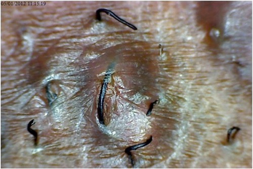 Figure 4 Trapped hair separating from the papule.