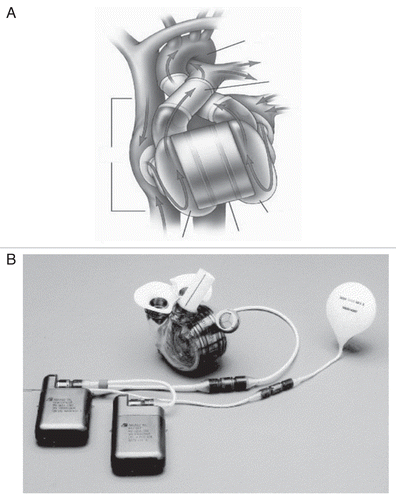 Figure 10 (A) The AbioCor total artificial heart (TAH) implanted, reprinted with permission from Abiomed, Inc. (B) AbioCor TAH components (J Thorac Cardiovasc Surg 2004; 127:131–41; Fig. 1).