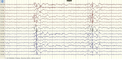 Figure 1. EEG of the patient demonstrating epileptic activity at admission.