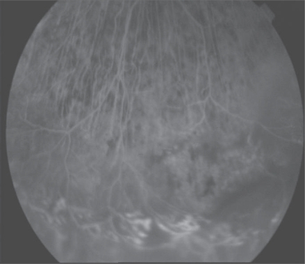 Figure 3 Fluorescein angiogram (FA) showed retinal telangiectasia and serous retinal detachment.