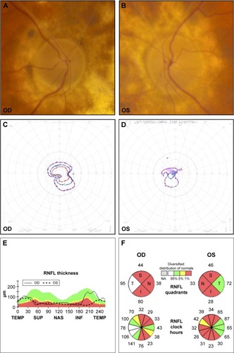 Figure 4 Patient 4.