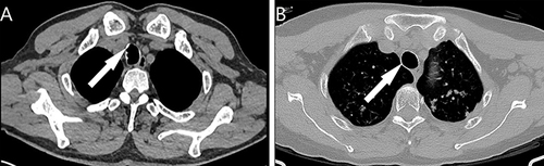Figure 1 Chest CT results of TO demonstrated calcified nodules in the anterolateral wall protruding into the tracheal lumen. (A) Calcified nodules in the anterior wall (arrow). (B) Calcified nodules in the lateral wall (arrow).
