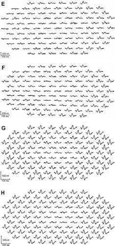 Figure 1 Multifocal electroretinogram (ERGs) of right and left eye of patient 1 (A, B), patient 2 (C, D), patient 3 (E, F), and patient 4 (G, H). Foveal amplitudes are decreased in all eyes. Especially in patient 3, amplitudes are attenuated widely including ring 5 and 6, although full-field ERG showed normal amplitude.