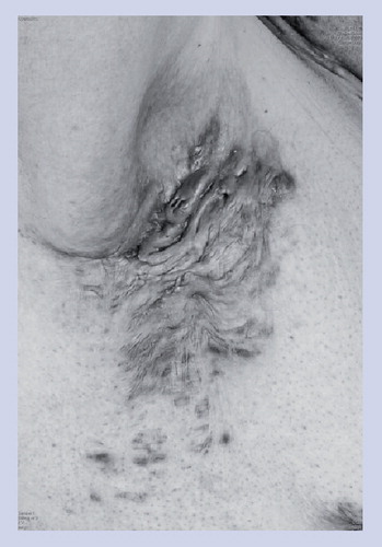 Figure 1. Chronic hidradenitis suppurativa of the axilla with multiple scarring interconnected tracts and abscesses throughout an entire area; Hurley stage III.