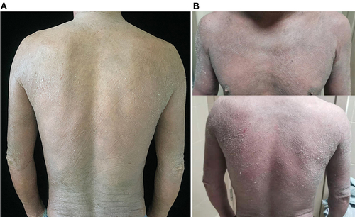 Figure 1 Scaling after dupilumab injection. (A) Lesions on the first day of desquamation after the third injection of dupilumab. (B) Lesions on the third day of desquamation after the third injection of dupilumab.