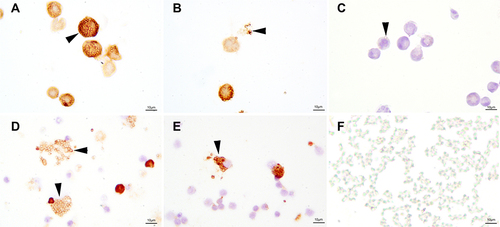 Figure 6 CD86 stain of T. marneffei conidia co-culture with THP-1 cells and PBMCs by immunohistochemistry. Mounds of T. marneffei conidia and macrophage cells had positive expression of CD86. The T.marneffei conidia with CD86 stain looked like signet rings. In (A), CD86 stained both T. marneffei conidia and THP-1 cells in the OE group. (B) In the CON group, CD86 stained both T. marneffei conidia and THP-1 cells. (C) Negative CD86 staining of T. marneffei conidia and THP-1 cells in the absence of a primary control. (D and E) T. marneffei conidia and scattered cells of PBMCs had positive expression of CD86 when the conidia were co-cultured with PBMCs. (F) Negative CD86 stain of T. marneffei conidia cultured without macrophages (original magnification: ×1000).