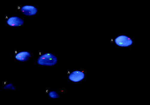 Figure 1.  FISH on sperm AneuVysion LSI (13/21) probe. FISH probes: 13-green, 21-orange.Normal spermatozoa with haploid number of chromosomes: A) (13/21). Spermatozoa with chromosome aneuploidies: B) disomy 21 (13/21,21); C) nullisomy 13 (0/21); and D) nullisomy 13 with disomy 21 (0/21,21). Excluded: E) overlapping cells and F) not hybridized.