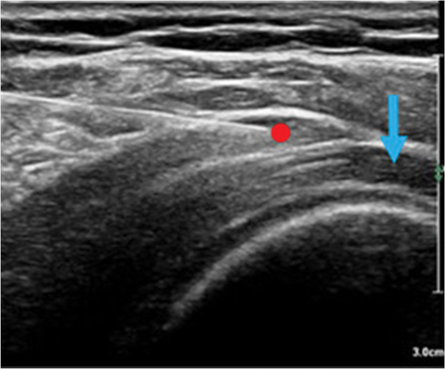 Figure 2. Ultrasound-guided sub acromial bursa injection. The blue arrow indicates the tendon tear and the red dot indicates the needle tip.