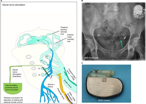 Figure 4 Sacral nerve stimulation with InterStim® device and pelvic anatomy for dorsal genital nerve (DGN) stimulation and percuteneous tibial nerve stimulation.