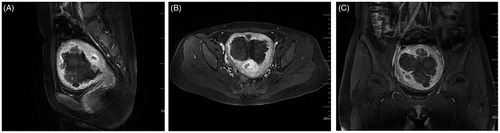 Figure 3. Enhanced MRI image obtained from the patient with DUL 1 day after HIFU treatment. The sagittal (A), transverse (B) and coronal (C) contrast-enhanced T1-weighted MRI showed nonperfusion areas within the uterus, indicating complete myoma nodule ablation one day after HIFU treatment.