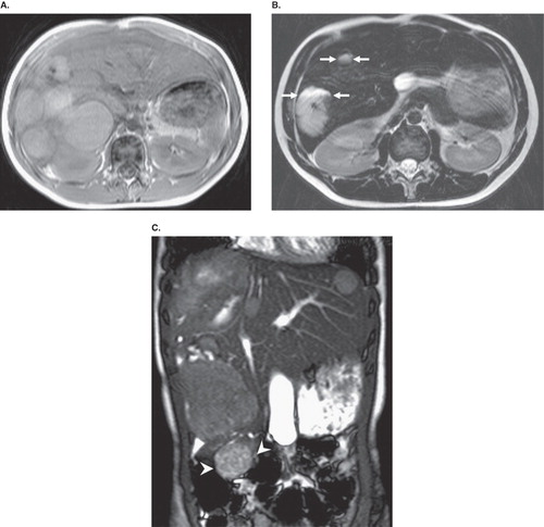 Figure 1.  Non-contrast T1-weighted axial magnetic resonance (MR) image (A) shows multiple well defined circumscribed hyperintense masses. On T2-weighted axial MR image (B), lesions demonstrate high signal intensity changes. Two lesions also reveal fluid-fluid level (arrows). On coronal T2-weighted turbo-spin echo MR image (C) one right lobe mass extends outside the liver contours (arrowheads).