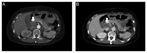 Figure 1. The sizes of the lymph nodes in the hepatic portal region were 19.1 mm and 19.5 mm (−30%~+20%; shortest diameter rule, RECIST 1.1), which were not significantly different before (A) and after (B) sorafenib monotherapy.