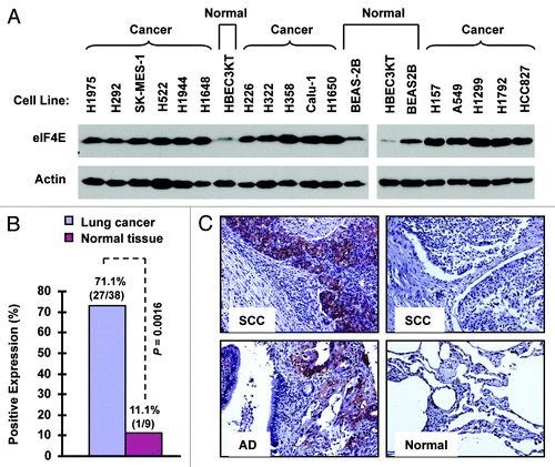 Figure 1. eIF4E expression is elevated in human NSCLC cell lines (A) and tissues (B and C). (A) Whole-cell protein lysates were extracted from the indicated normal and NSCLC cell lines and used for detection of eIF4E expression with western blotting. (B and C) eIF4E expression in human NSCLC tissues was detected with IHC and scored as positive or negative expression (B). The representative images were also presented (C). SCC, squamous cell carcinoma; AD, adenocarcinoma; Normal, adjacent normal lung tissue.
