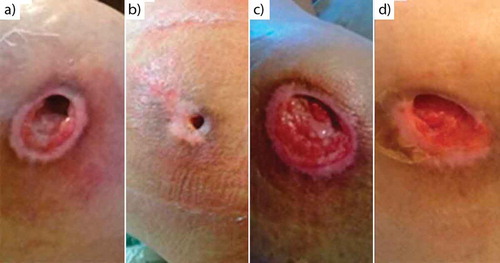 Figure 4. Chronological evolution of the ulcer on the glutes. Initial appearance for right (a) and for left (c), aspect of the ulcer at 70 days for the right (b) and for left (d).