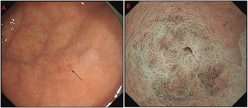 Figure 1. Endoscopic findings: (A) SMT-like changes were observed under white light endoscopy. (B) Narrow-band imaging with magnifying endoscopy findings.